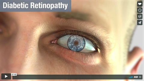 Diabetic retinopathy animation