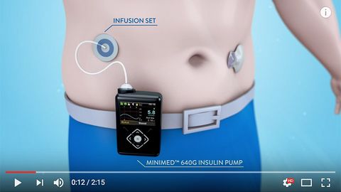 Medtronic - MiniMed 640G